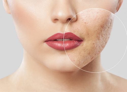 Facial & acne scars
