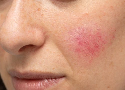 Woman's face with rosacea