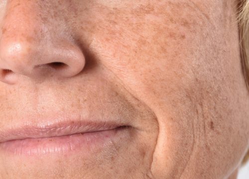 Woman with age spots