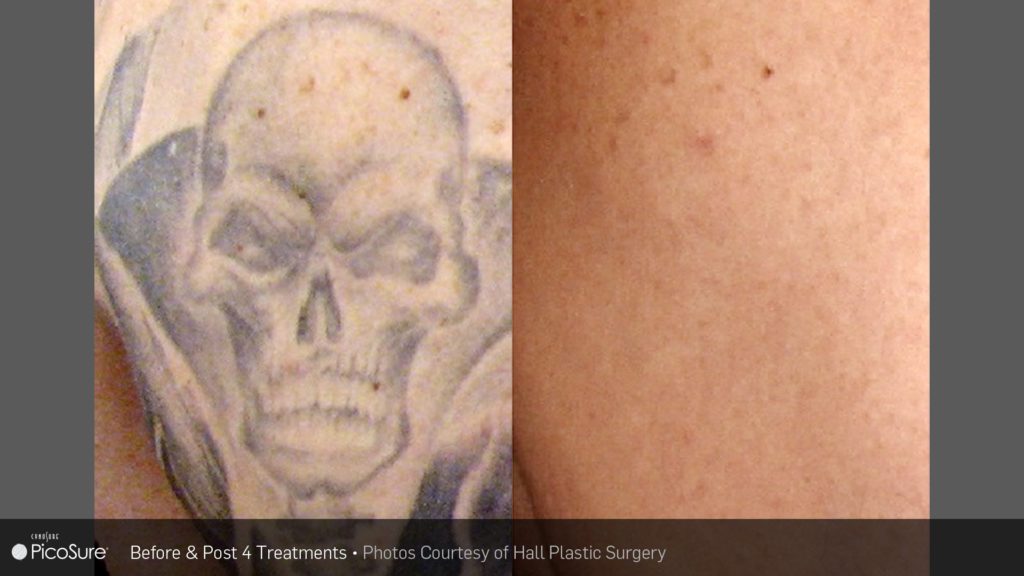 Before and after tattoo removal