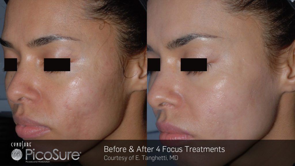 Before and after PicoSure Focus treatments