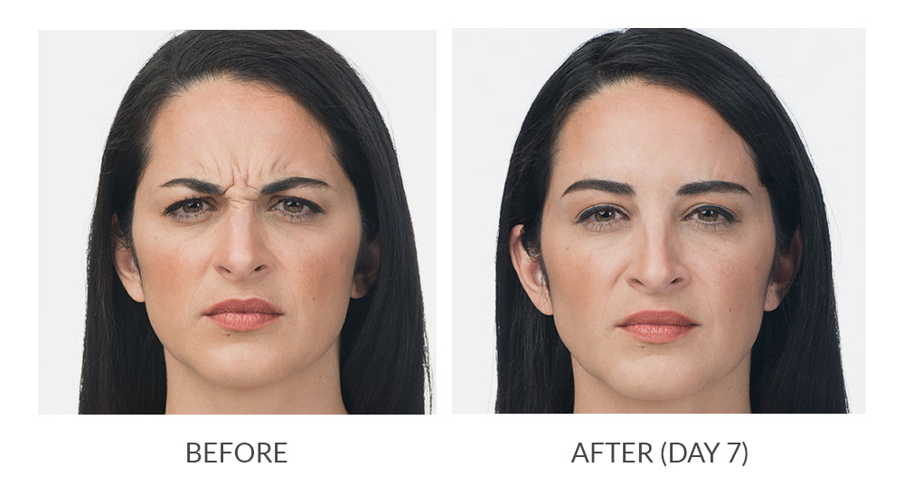 before and after results botox