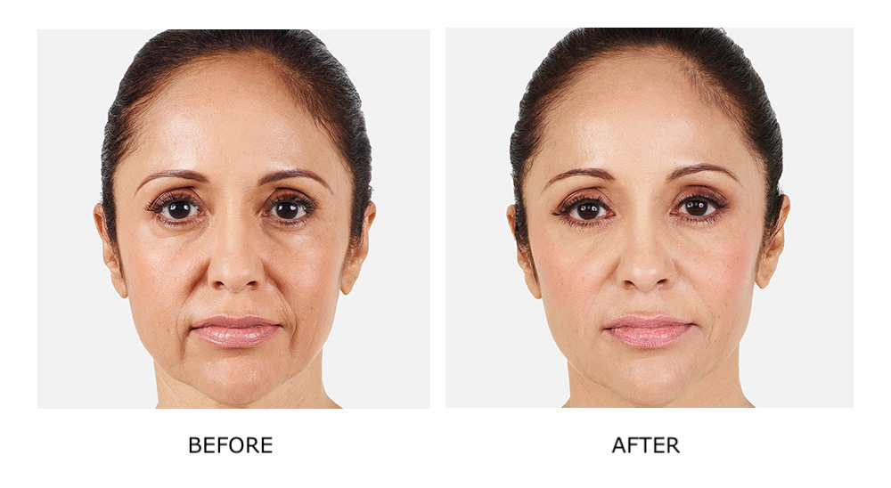 before and after results juvederm